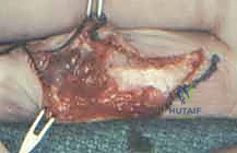 استخدام الميكروسكوب الجراحي لفصل الأوعية