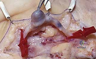 التخطيط الجراحي الدقيق قبل العملية
