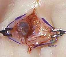 الأسباب الجينية والمكتسبة لأورام اليد