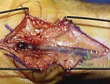 استئصال الورم الوعائي بدقة متناهية