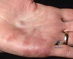 أعراض الأورام الوعائية في اليد