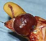 استئصال أورام اليد الوعائية: دليل شامل للمرضى مع الأستاذ الدكتور محمد هطيف