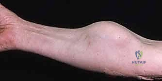 تأثير الأورام على شبكة اليد العصبية والوعائية