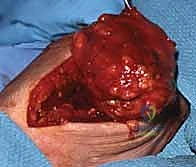 صورة توضيحية لـ استئصال أورام اليد الوعائية: دليل شامل للمرضى مع الأستاذ الدكتور محمد هطيف