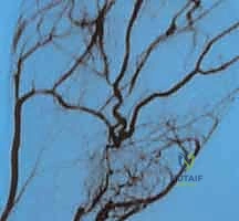 صورة توضيحية لـ استئصال أورام اليد الوعائية: دليل شامل للمرضى مع الأستاذ الدكتور محمد هطيف