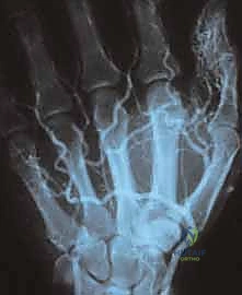 صورة توضيحية لـ استئصال أورام اليد الوعائية: دليل شامل للمرضى مع الأستاذ الدكتور محمد هطيف