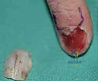 النتيجة الفورية بعد استئصال الورم