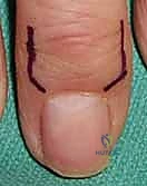 الحفاظ على الأعصاب والأوتار المحيطة