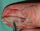 صورة توضيحية لـ استئصال أورام اليد الوعائية: دليل شامل للمرضى مع الأستاذ الدكتور محمد هطيف