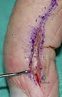 إغلاق الجرح بتقنيات تجميلية