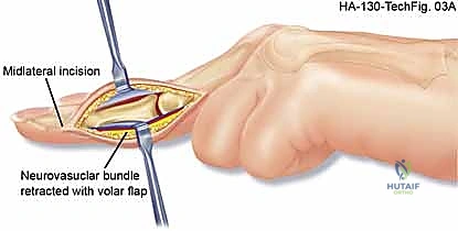 صورة توضيحية لـ استئصال أورام اليد الوعائية: دليل شامل للمرضى مع الأستاذ الدكتور محمد هطيف