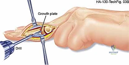 صورة توضيحية لـ استئصال أورام اليد الوعائية: دليل شامل للمرضى مع الأستاذ الدكتور محمد هطيف