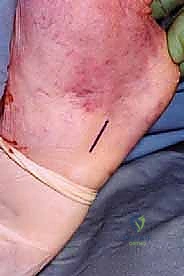 أعراض التمزق المزمن لوتر العرقوب