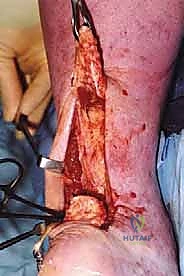 العوامل المؤدية لتمزق وتر العرقوب