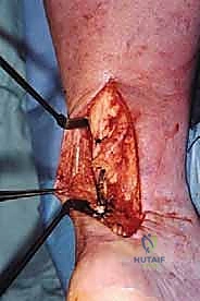 خيارات العلاج لتمزق وتر العرقوب