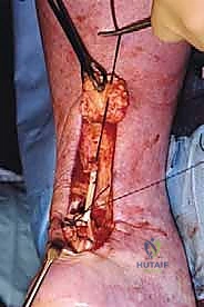 التشخيص الدقيق بالرنين المغناطيسي لتمزق وتر العرقوب