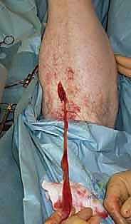 تقنية نقل وتر العضلة المثنية الطويلة FHL