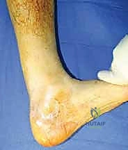 تمزق وتر أخيل المزمن: دليل شامل للعلاج بالطعوم الخيفية