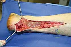 التغيرات النسيجية في وتر أخيل المزمن