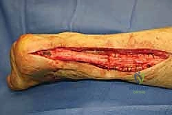 برنامج التأهيل والعلاج الطبيعي بعد جراحة وتر أخيل