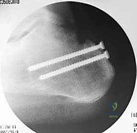 صورة توضيحية لـ تمزق وتر أخيل المزمن: دليل شامل للعلاج بالطعوم الخيفية مع الأستاذ الدكتور محمد هطيف