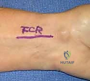 دقة الجراحة في منطقة المعصم