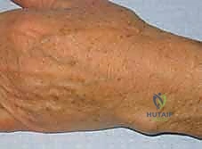 شكل الكيس العقدي في المعصم