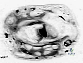 الشفط بالإبرة كحل مؤقت
