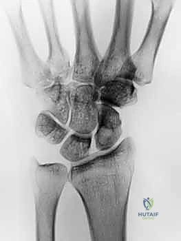 استئصال أورام اليد والمعصم: الدليل الشامل من الأستاذ الدكتور محمد هطيف في صنعاء