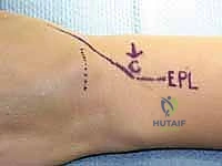 استخدام الميكروسكوب الجراحي لفصل الأنسجة