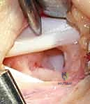 صورة توضيحية لـ استئصال أورام اليد والمعصم: الدليل الشامل من الأستاذ الدكتور محمد هطيف في صنعاء