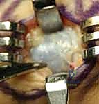 استخدام الرنين المغناطيسي لتشخيص أورام اليد