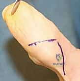 صورة توضيحية لـ استئصال أورام اليد والمعصم: الدليل الشامل من الأستاذ الدكتور محمد هطيف في صنعاء