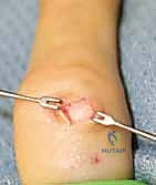 تحضير المريض والتخدير الموضعي