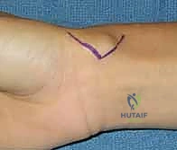 صورة توضيحية لـ استئصال أورام اليد والمعصم: الدليل الشامل من الأستاذ الدكتور محمد هطيف في صنعاء