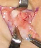 صورة توضيحية لـ استئصال أورام اليد والمعصم: الدليل الشامل من الأستاذ الدكتور محمد هطيف في صنعاء