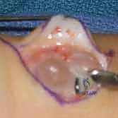 صورة توضيحية لـ استئصال أورام اليد والمعصم: الدليل الشامل من الأستاذ الدكتور محمد هطيف في صنعاء