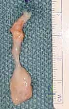 صورة توضيحية لـ استئصال أورام اليد والمعصم: الدليل الشامل من الأستاذ الدكتور محمد هطيف في صنعاء