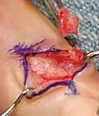 تأثير الإجهاد المتكرر على المعصم