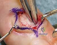 صورة توضيحية لـ استئصال أورام اليد والمعصم: الدليل الشامل من الأستاذ الدكتور محمد هطيف في صنعاء