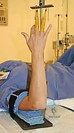 التعامل مع الأورام الصلبة في اليد