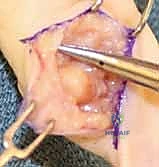 الأورام الشحمية في اليد