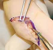 صورة توضيحية لـ استئصال أورام اليد والمعصم: الدليل الشامل من الأستاذ الدكتور محمد هطيف في صنعاء