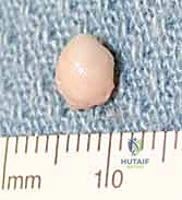 الشق الجراحي الدقيق