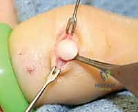 الأورام الوعائية وكيفية التعامل معها