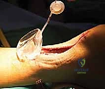 إعادة بناء وتر العرقوب المعقدة بتوسيع الأنسجة الرخوة: نهج الأستاذ الدكتور محمد هطيف الرائد في صنعاء