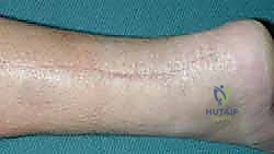 Staged Soft Tissue Expansion for Complex Achilles Tendon Reconstruction: An Intraoperative Masterclass