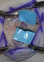 أورام الأعصاب الطرفية في اليد والرسغ: دليل شامل لاستئصالها وإعادة بنائها مع الأستاذ الدكتور محمد هطيف