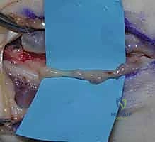 الفرق بين ورم شوان والورم الليفي العصبي