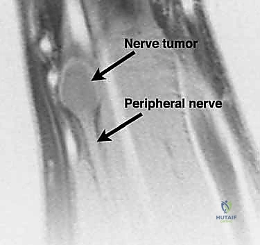 تقييم الألم والضعف الحركي